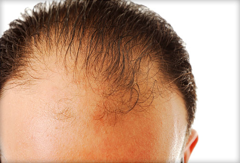 how to regrow hair at bald patches